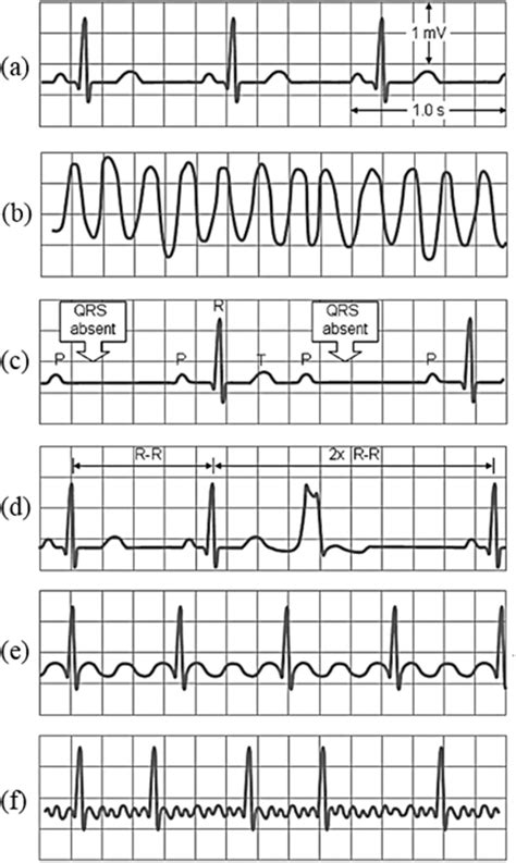 abnormal ekg results|What an EKG Test Can Tell Your Doctor About Your .